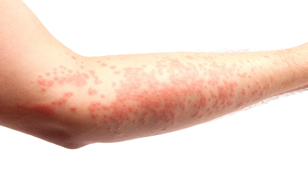Eczema on an arm