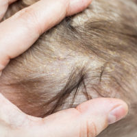 Seborrheic Dermatitis on the scalp