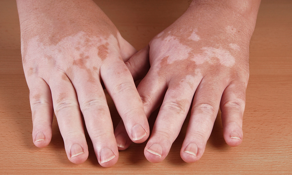 Vitiligo on the hands