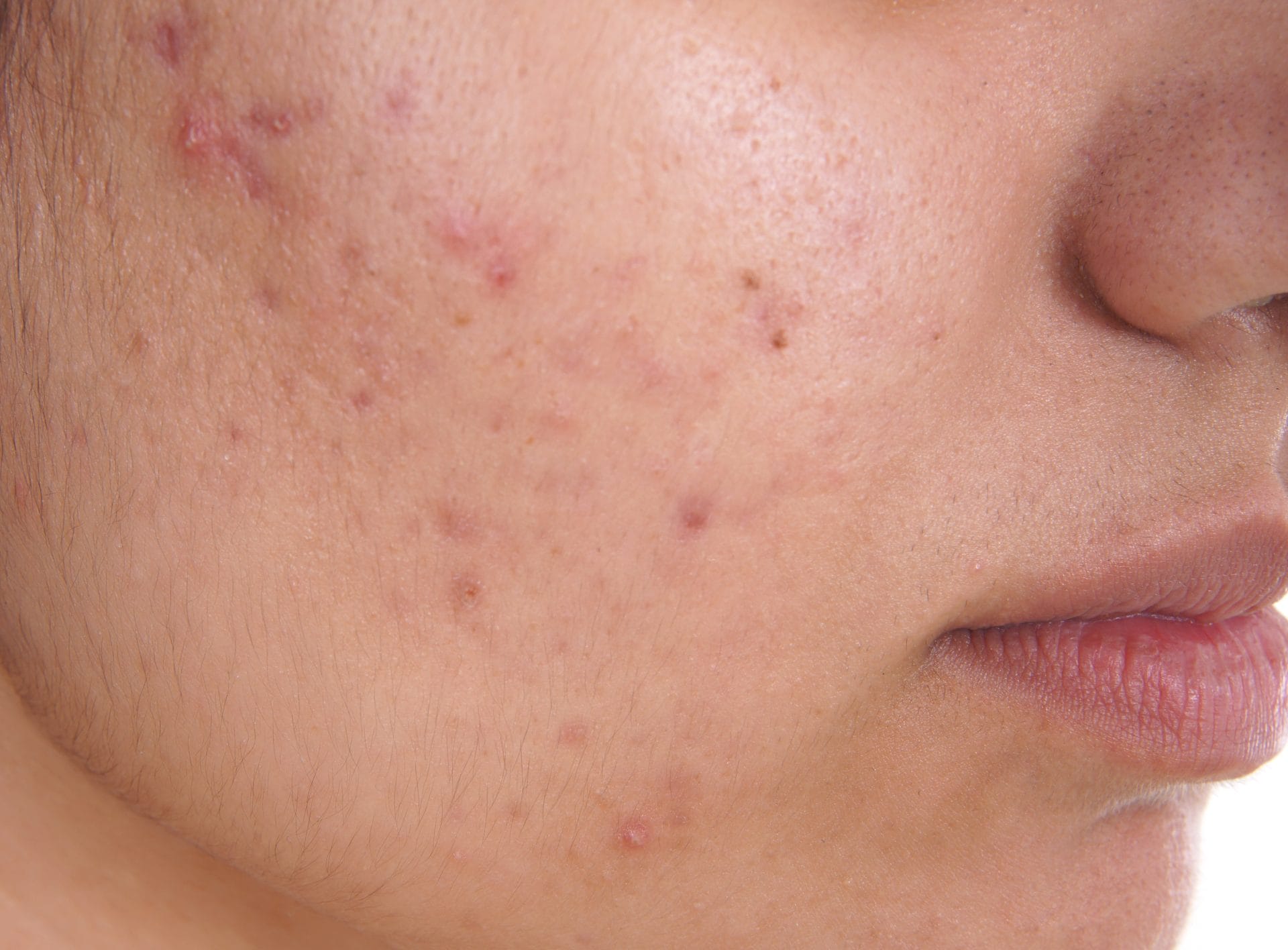 Acne_1-3675×2710-2269141